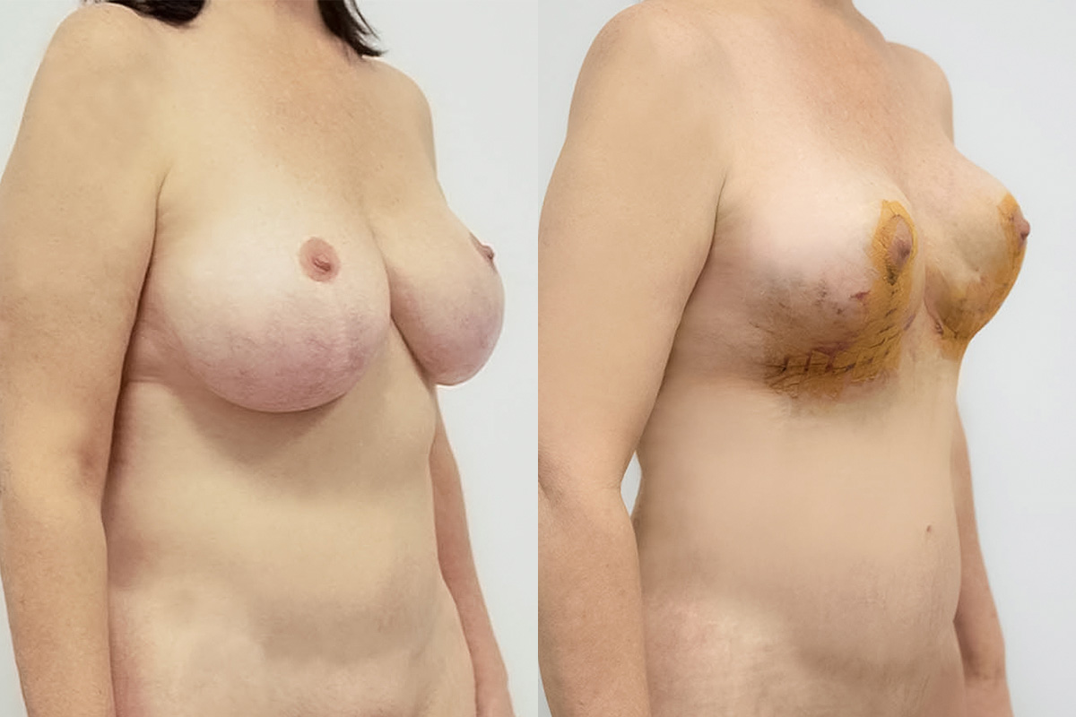 Breast Lift Before & After Gallery - Patient 64084064 - Image 2