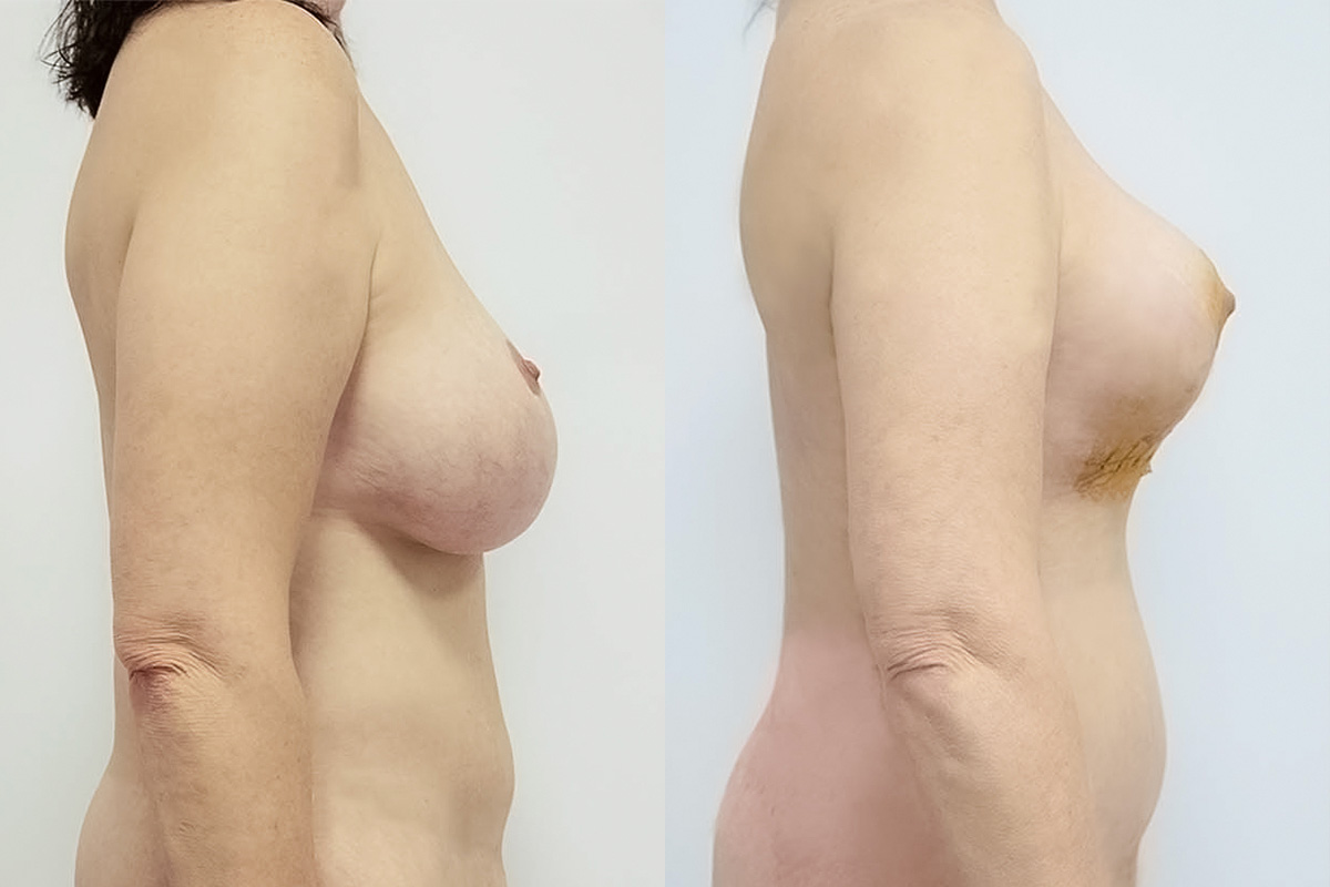 Breast Lift Before & After Gallery - Patient 64084064 - Image 3