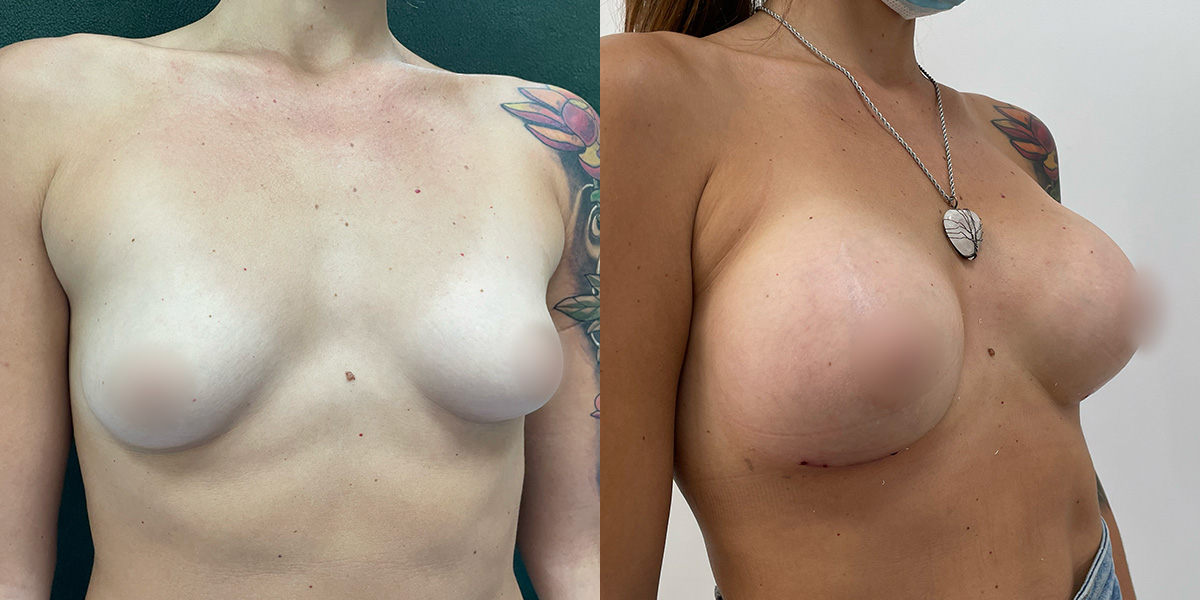 Breast Augmentation Before & After Gallery - Patient 55793687 - Image 2