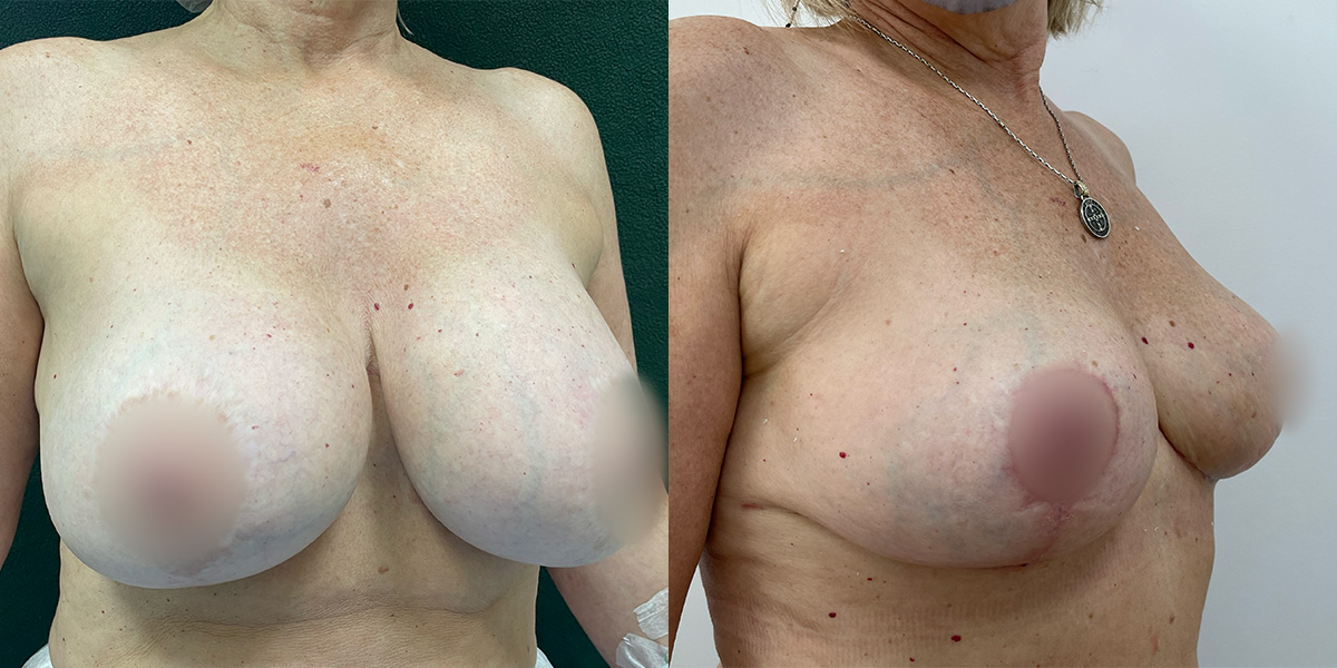 Breast Reduction Before & After Gallery - Patient 55793689 - Image 2