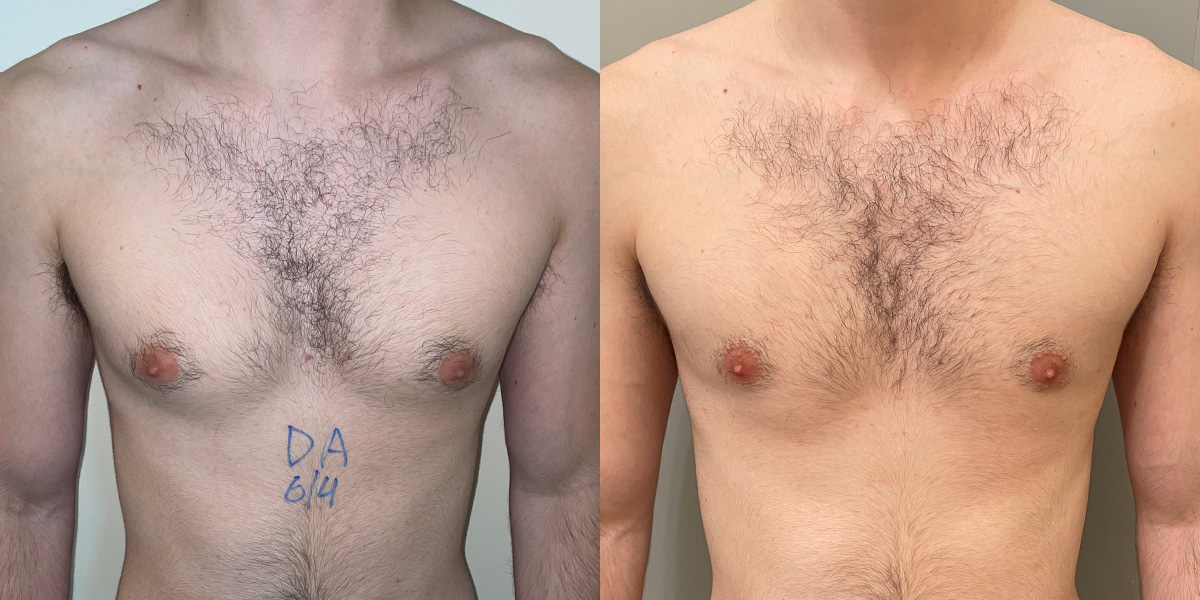 Gynecomastia Before & After Gallery - Patient 55793695 - Image 1