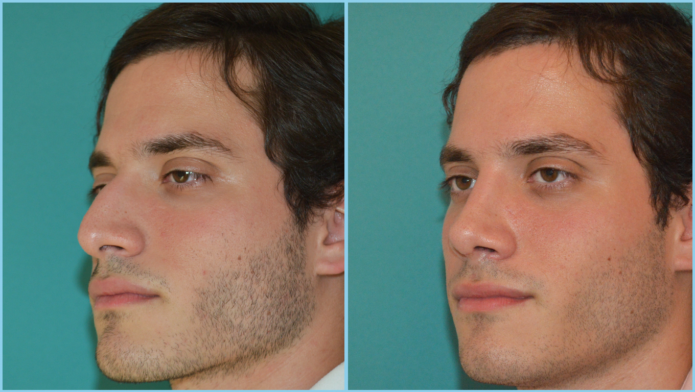 Rhinoplasty Before & After Gallery - Patient 55959445 - Image 3