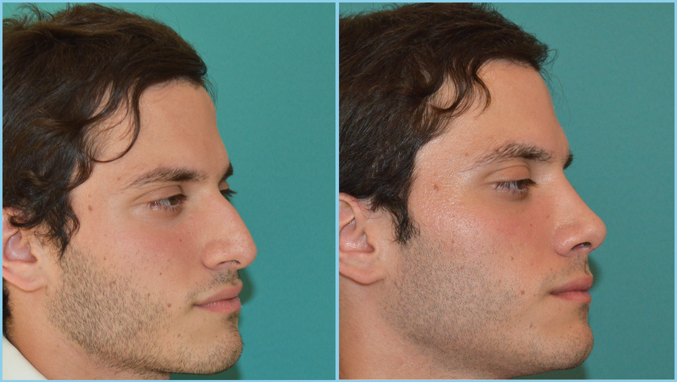 Rhinoplasty Before & After Gallery - Patient 55959445 - Image 4