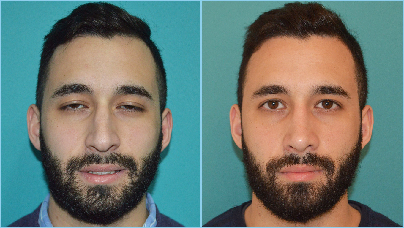 Rhinoplasty Before & After Gallery - Patient 55959448 - Image 2