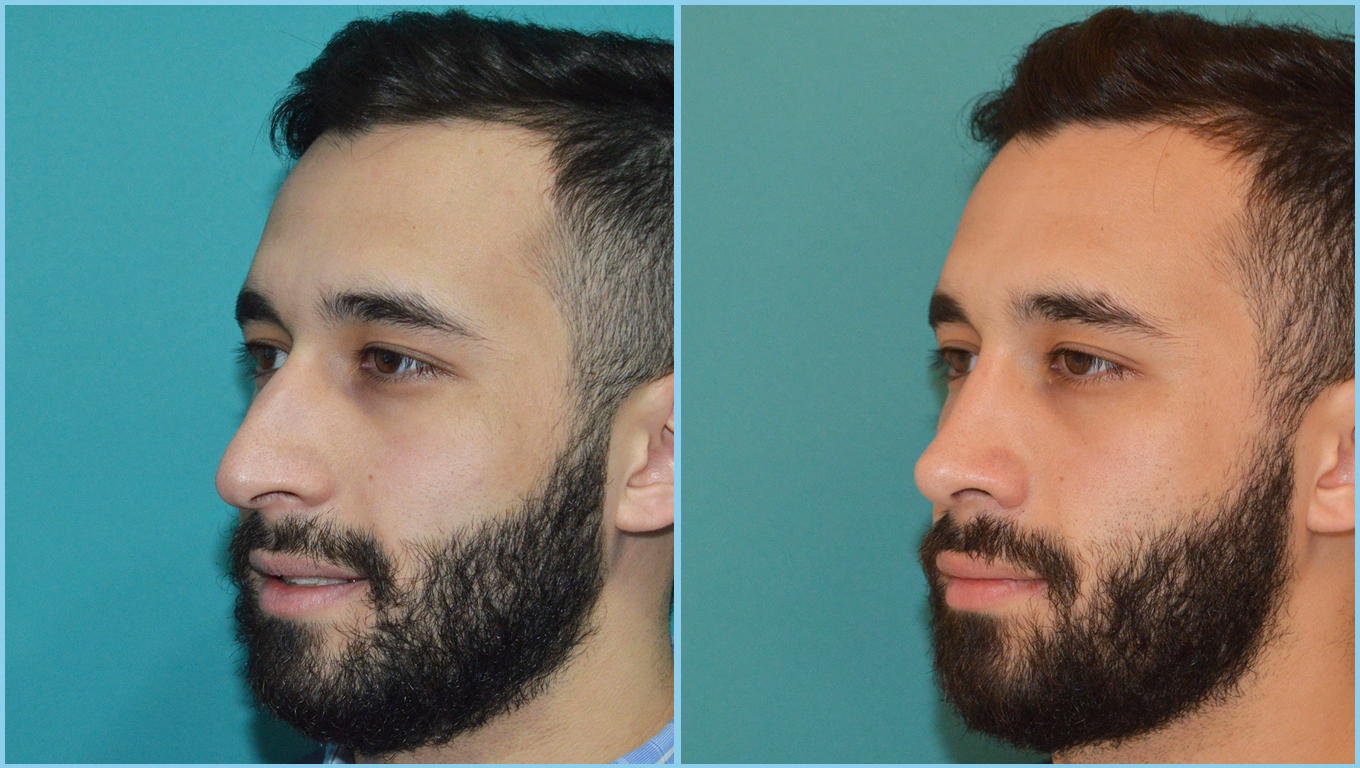 Rhinoplasty Before & After Gallery - Patient 55959448 - Image 3