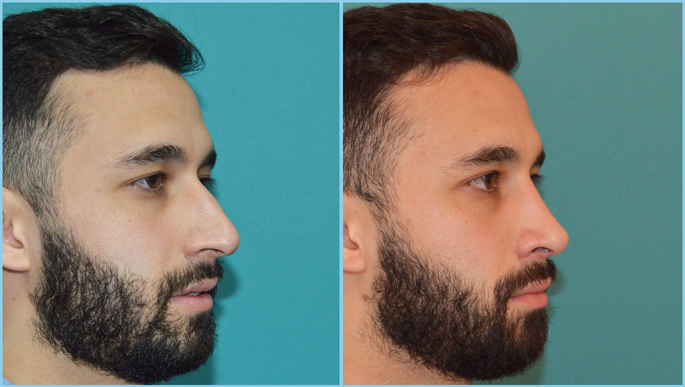 Rhinoplasty Before & After Gallery - Patient 55959448 - Image 4
