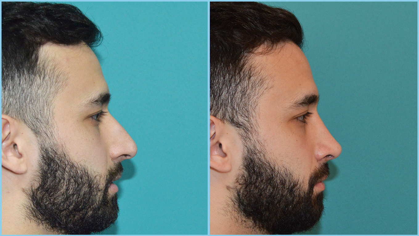 Rhinoplasty Before & After Gallery - Patient 55959448 - Image 5