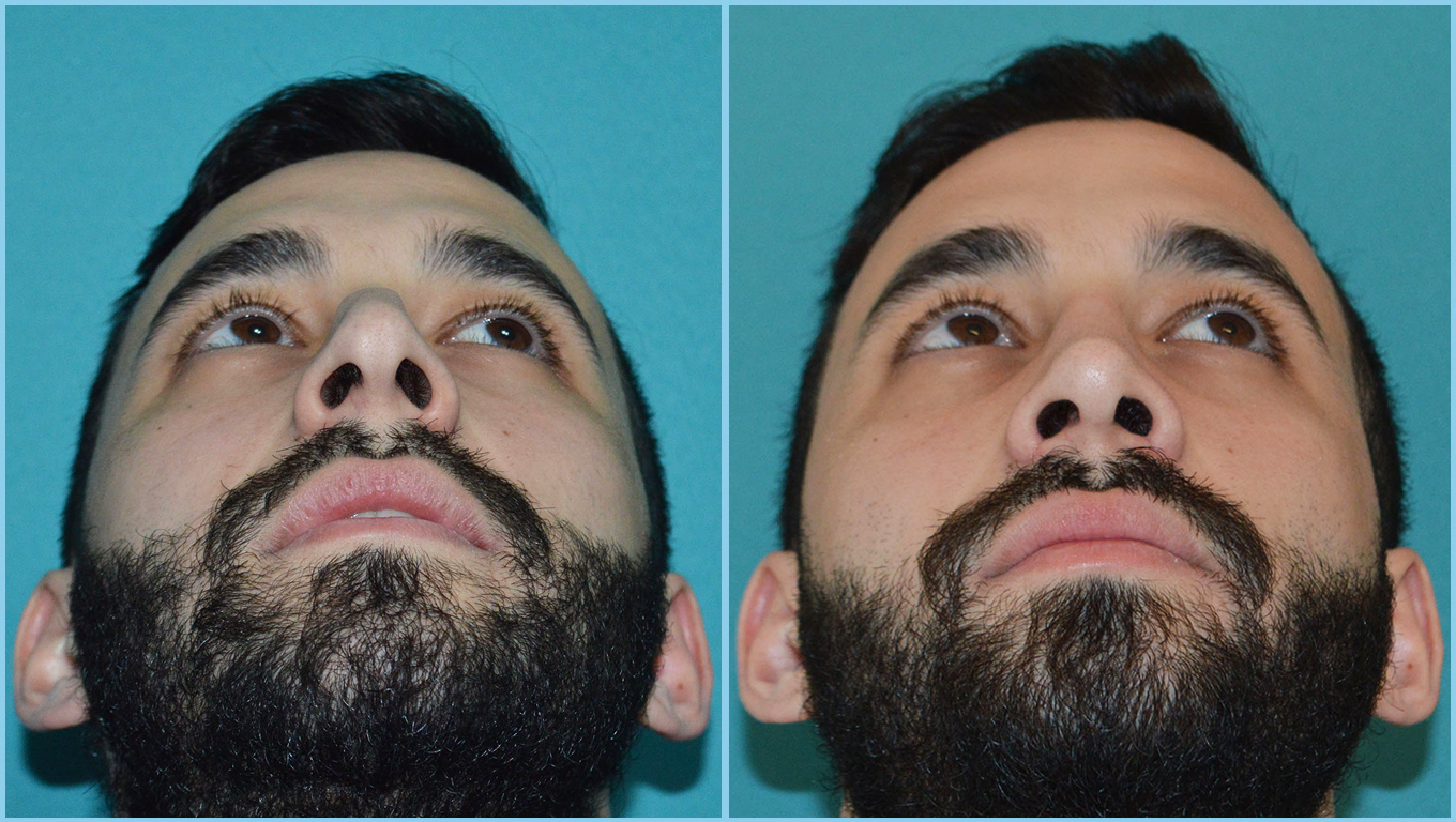 Rhinoplasty Before & After Gallery - Patient 55959448 - Image 6