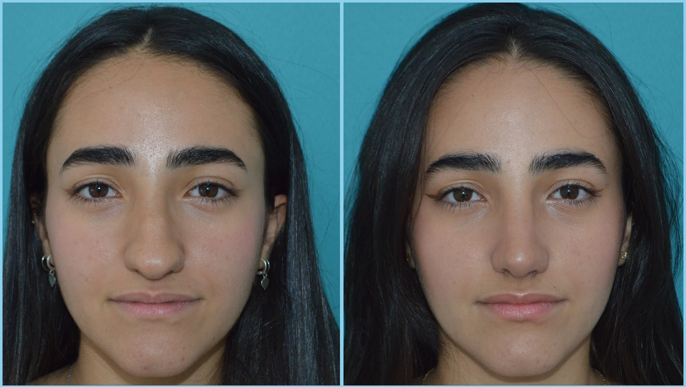 Rhinoplasty Before & After Gallery - Patient 55959457 - Image 2