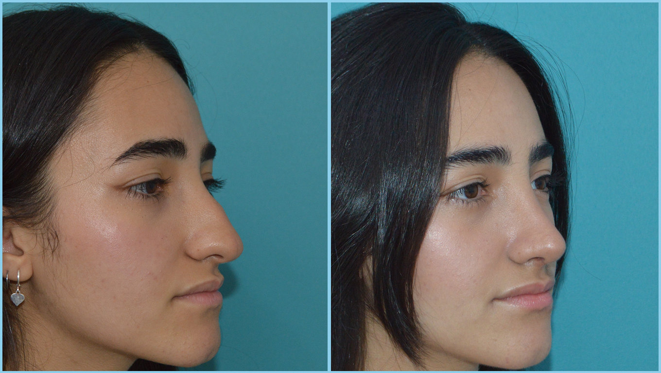 Rhinoplasty Before & After Gallery - Patient 55959457 - Image 3