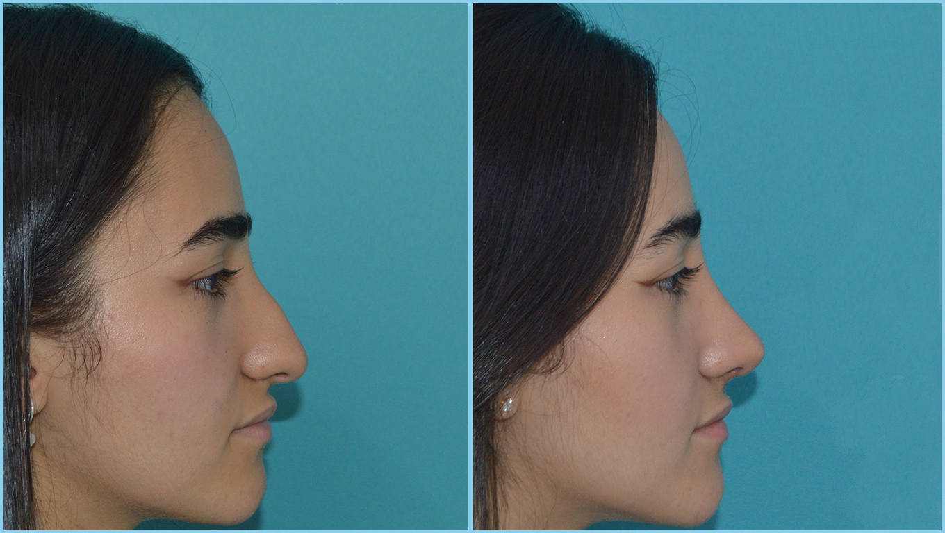 Rhinoplasty Before & After Gallery - Patient 55959457 - Image 1