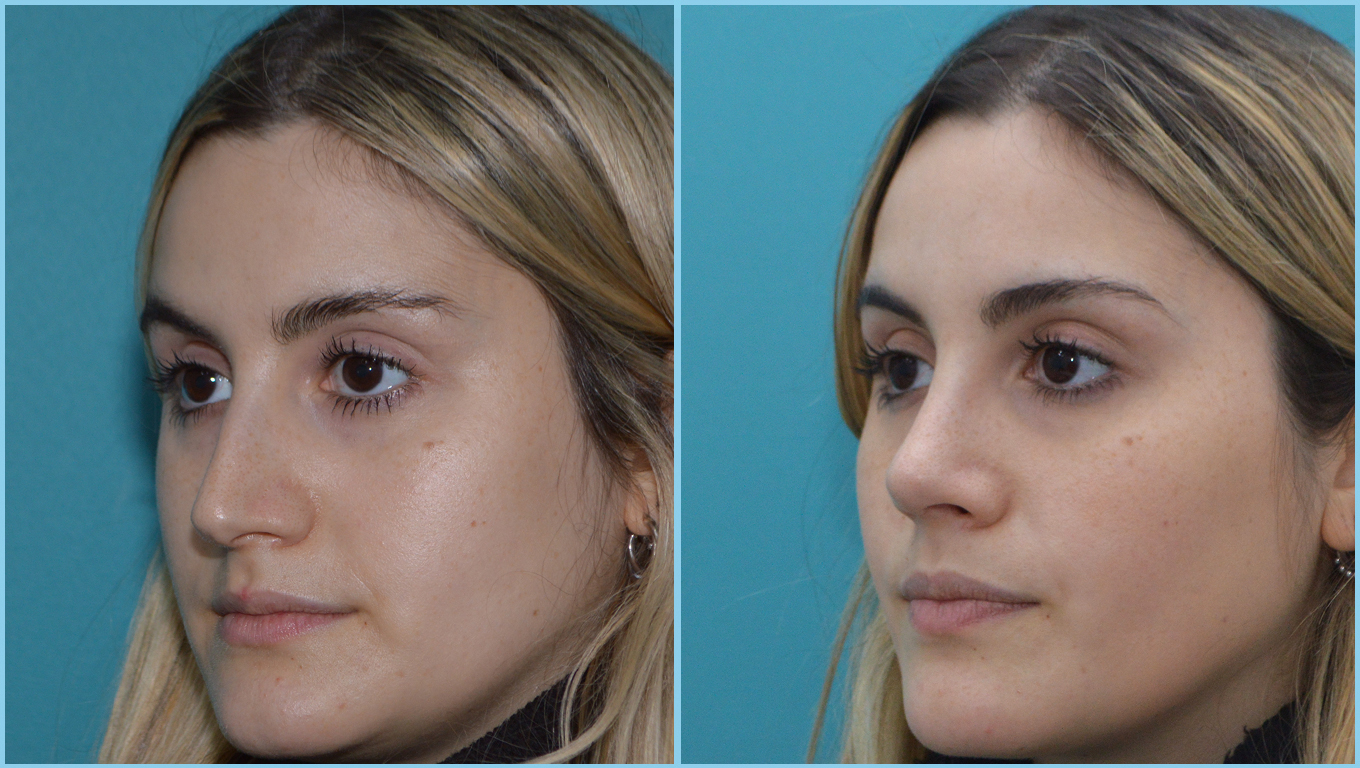 Rhinoplasty Before & After Gallery - Patient 55959458 - Image 3