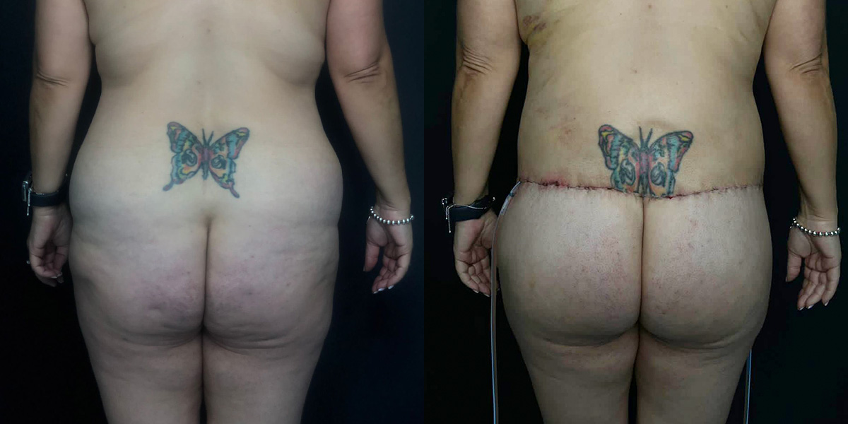 Brazilian Butt Lift Before & After Gallery - Patient 56112255 - Image 1
