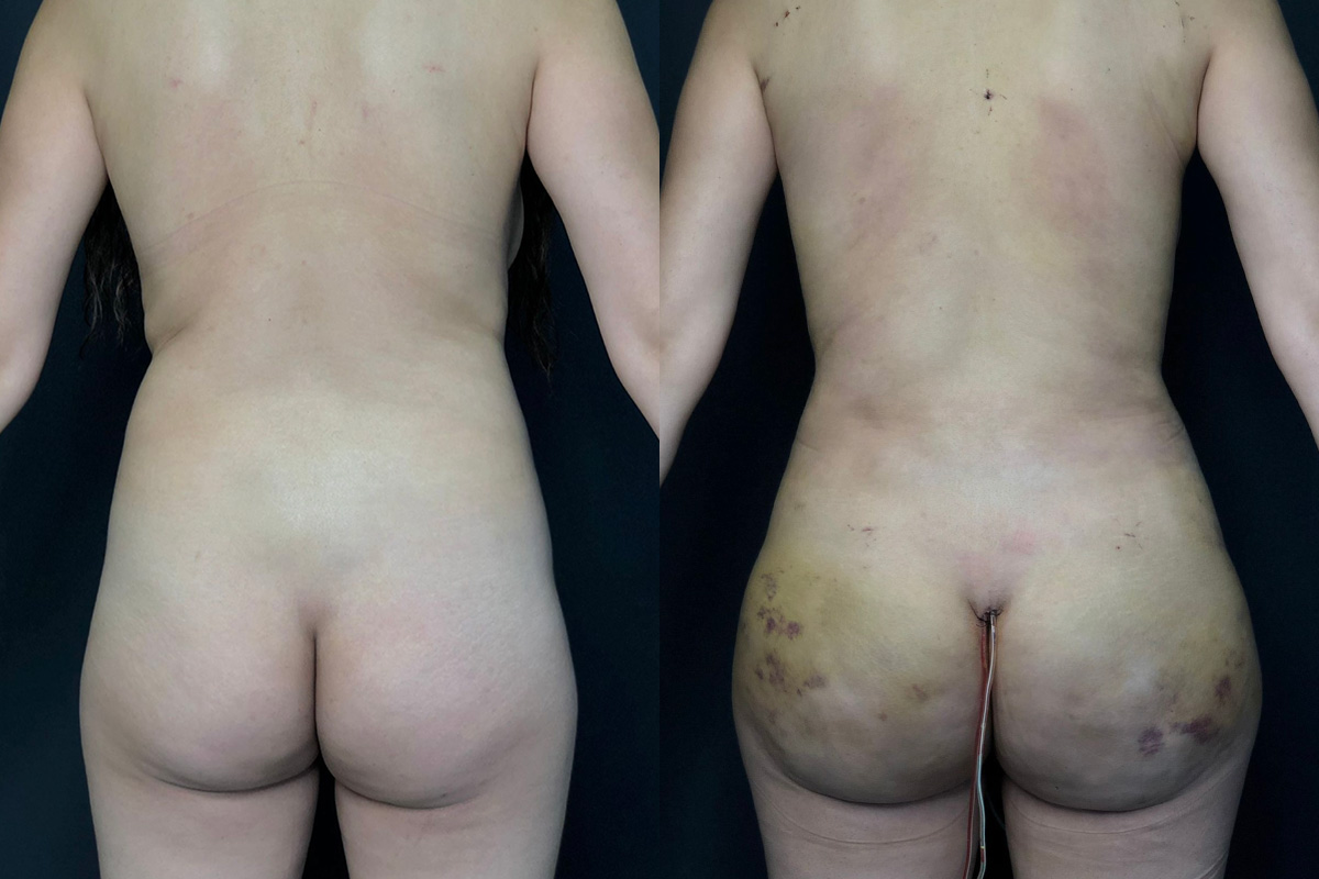 Brazilian Butt Lift Before & After Gallery - Patient 56112278 - Image 1