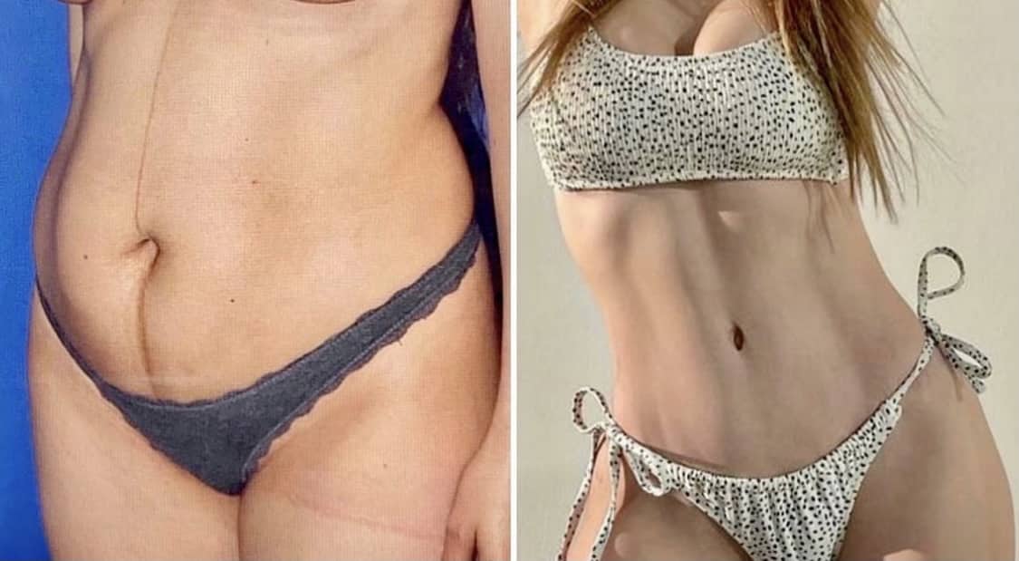Tummy Tuck Before & After Gallery - Patient 63244647 - Image 1