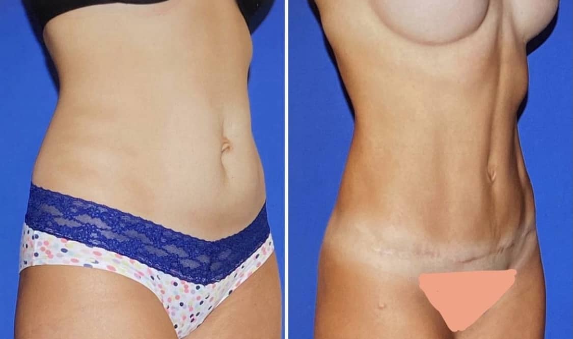 Tummy Tuck Before & After Gallery - Patient 63244648 - Image 1