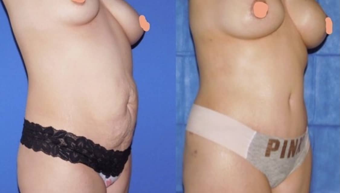Tummy Tuck Before & After Gallery - Patient 63244651 - Image 1