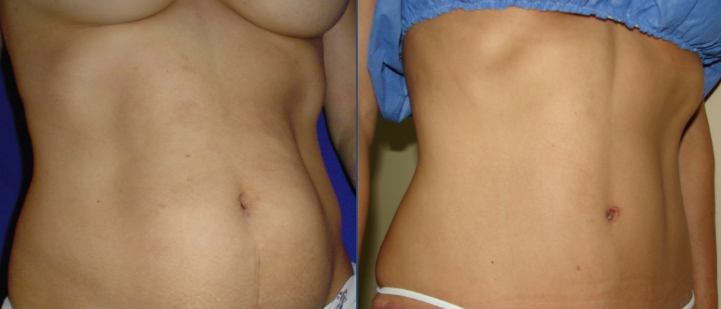 Tummy Tuck Before & After Gallery - Patient 63244658 - Image 1