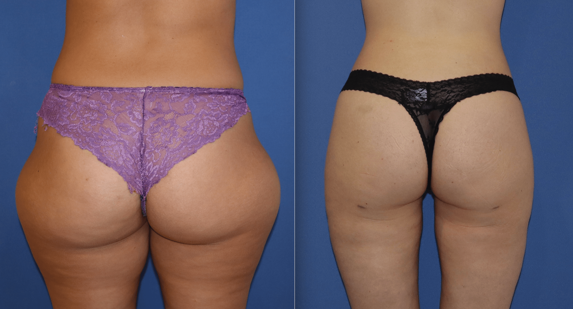 Brazilian Butt Lift Before & After Gallery - Patient 63244686 - Image 1