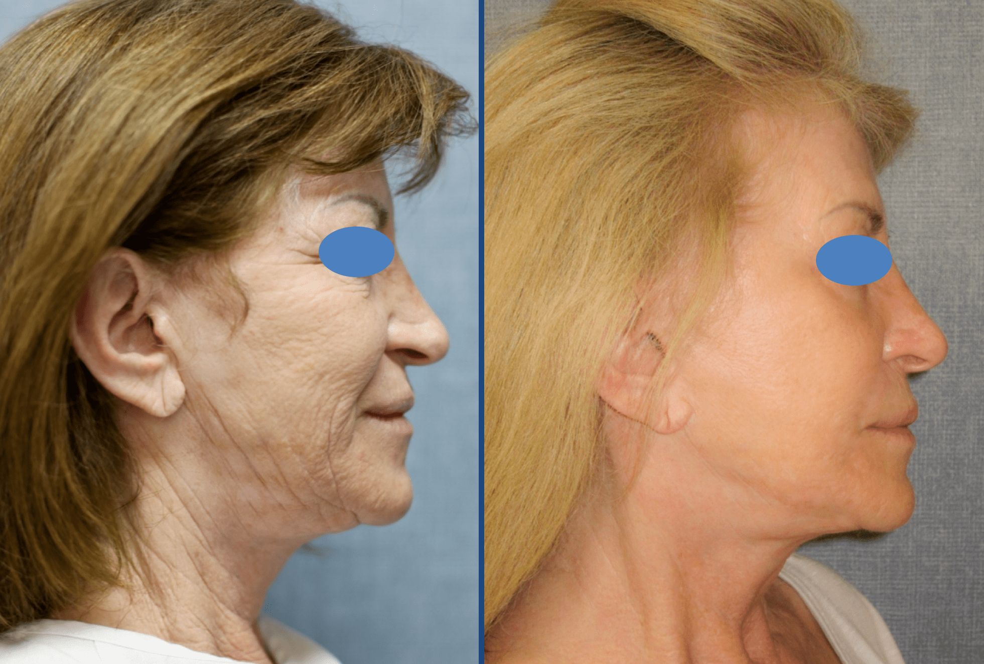 Neck Lift Before & After Gallery - Patient 63244774 - Image 1