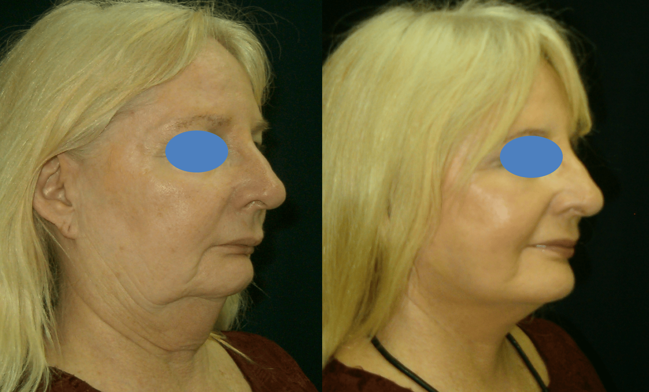 Neck Lift Before & After Gallery - Patient 63244776 - Image 1