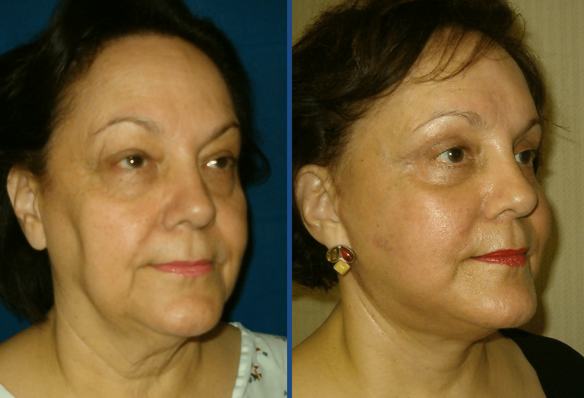 Facelift Before & After Gallery - Patient 63244745 - Image 1