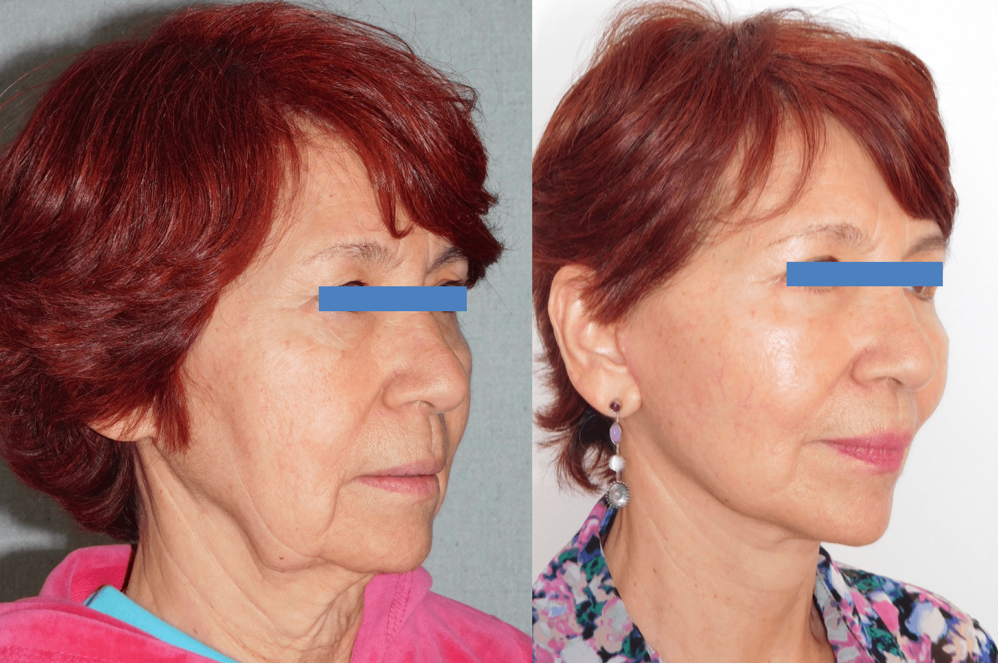 Neck Lift Before & After Gallery - Patient 63244778 - Image 1