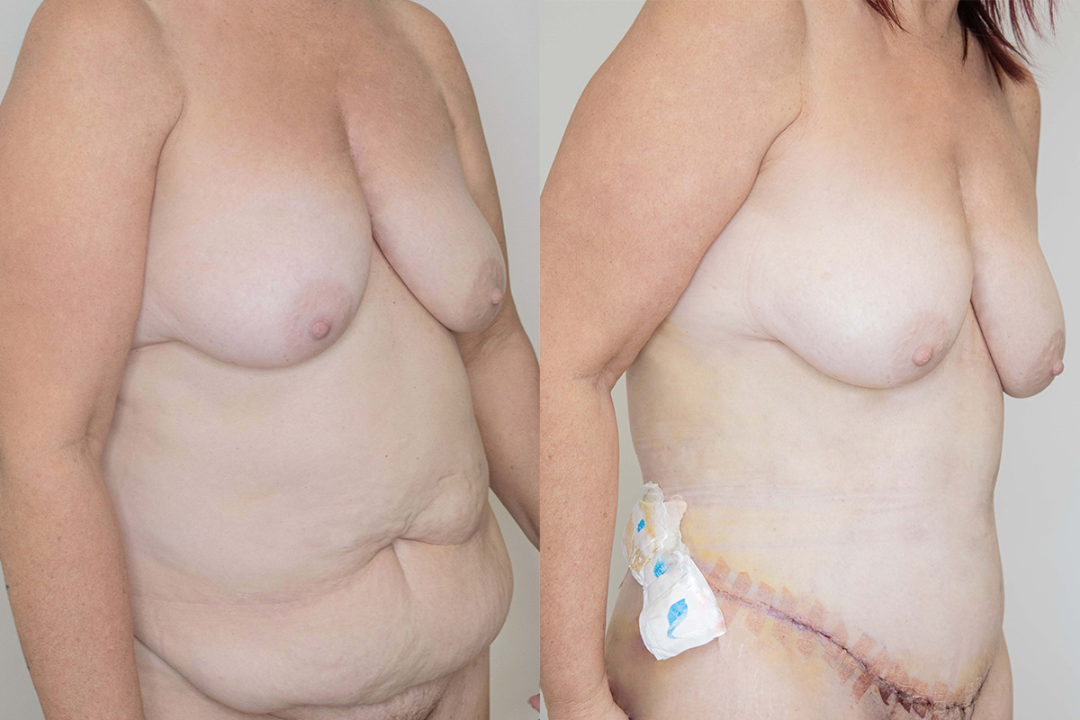 Tummy Tuck Before & After Gallery - Patient 64084025 - Image 2