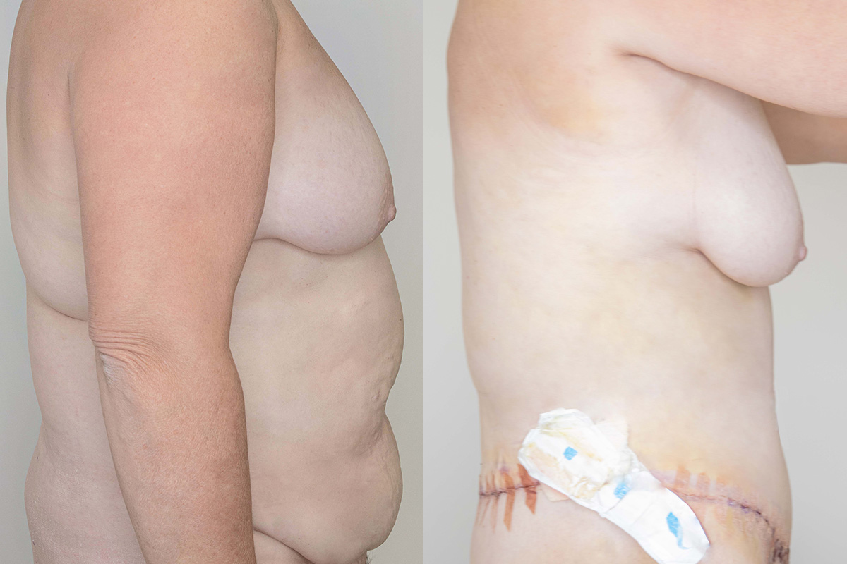 Tummy Tuck Before & After Gallery - Patient 64084025 - Image 3