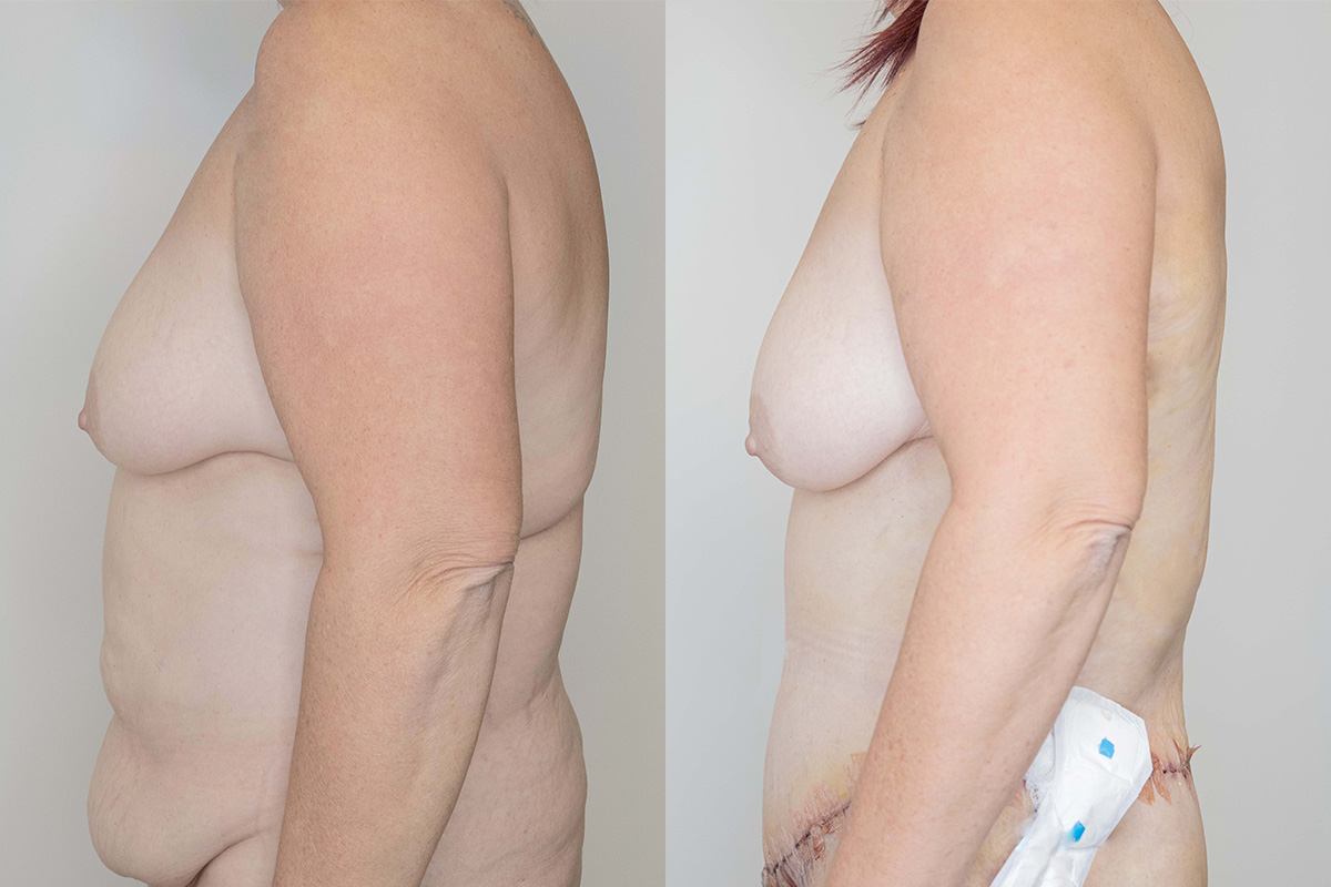 Tummy Tuck Before & After Gallery - Patient 64084025 - Image 4