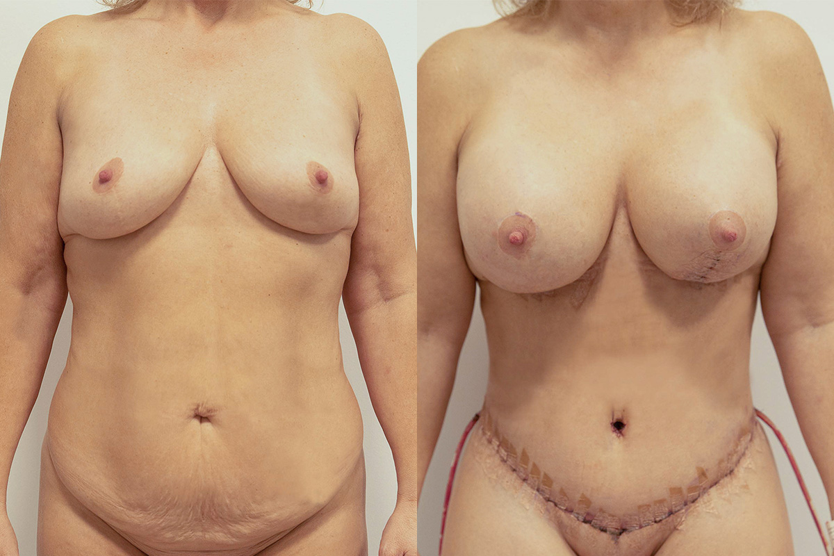 Lipotransfer Before & After Gallery - Patient 64084045 - Image 1