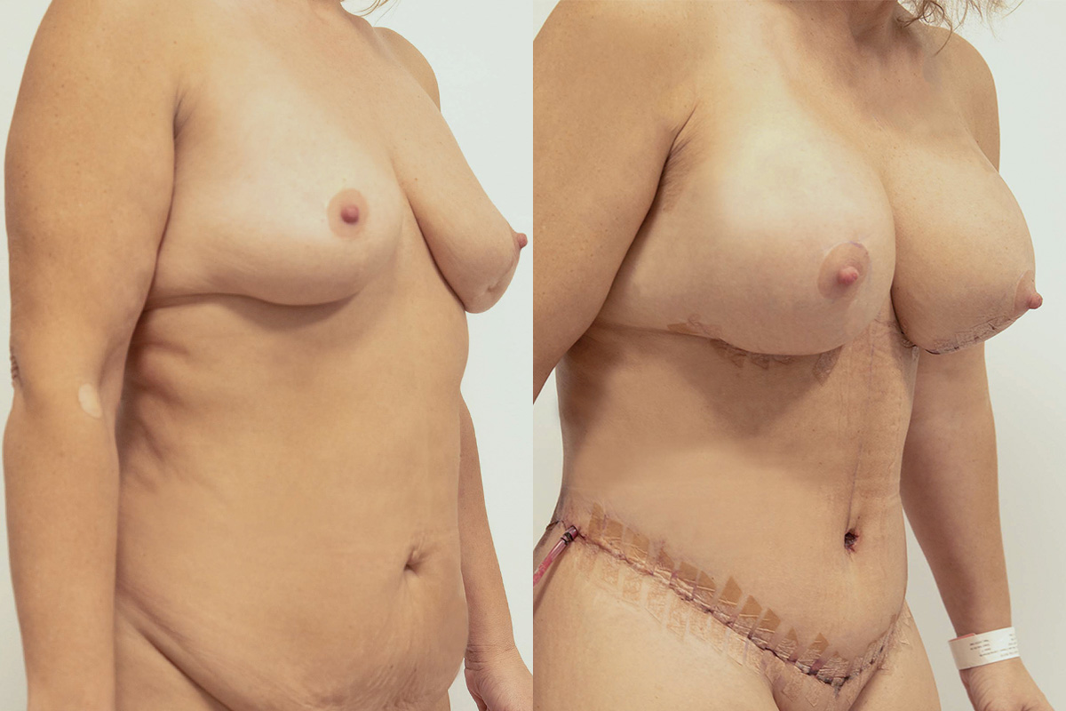 Lipotransfer Before & After Gallery - Patient 64084045 - Image 2