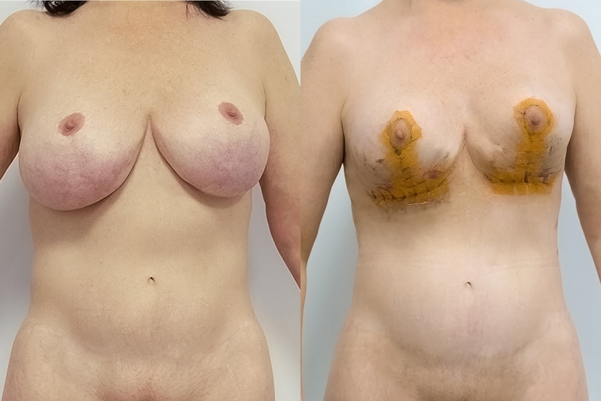 Liposuction Before & After Gallery - Patient 64084069 - Image 1