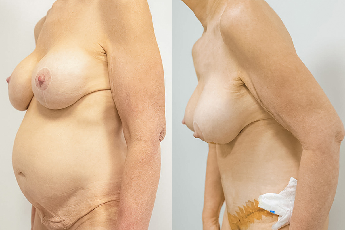 Tummy Tuck Before & After Gallery - Patient 64084224 - Image 2
