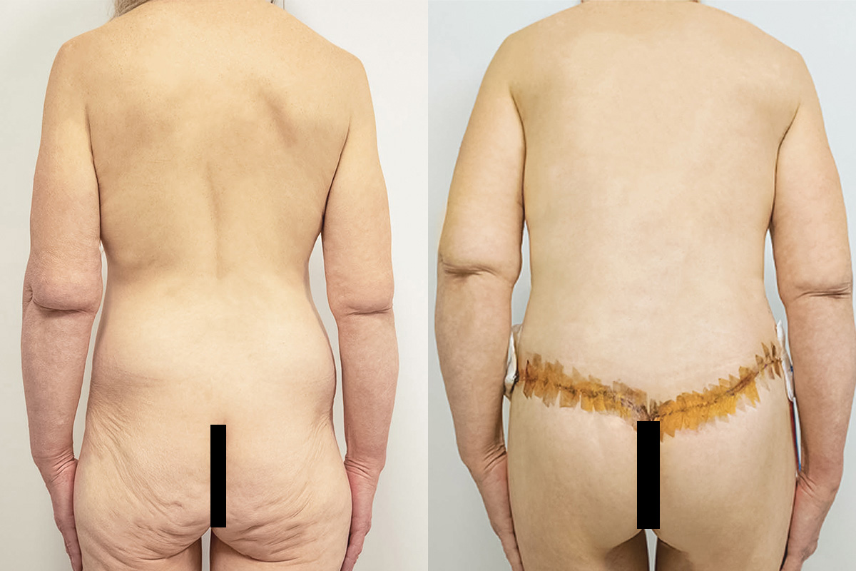Tummy Tuck Before & After Gallery - Patient 64084224 - Image 5