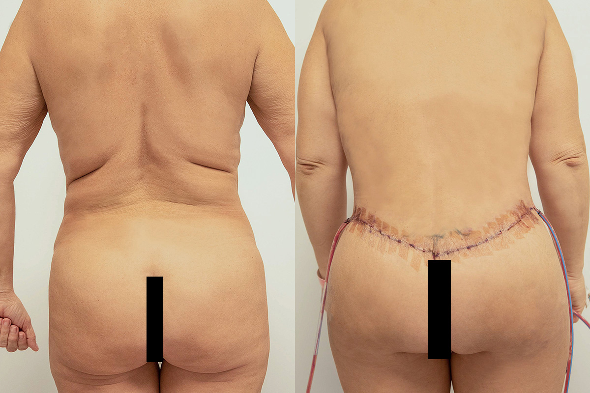 Lipotransfer Before & After Gallery - Patient 64084045 - Image 5